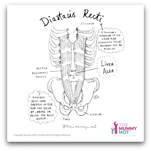 A drawing of diastasis recti in womens body