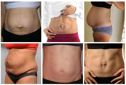 Various examples of pregnant women tummies